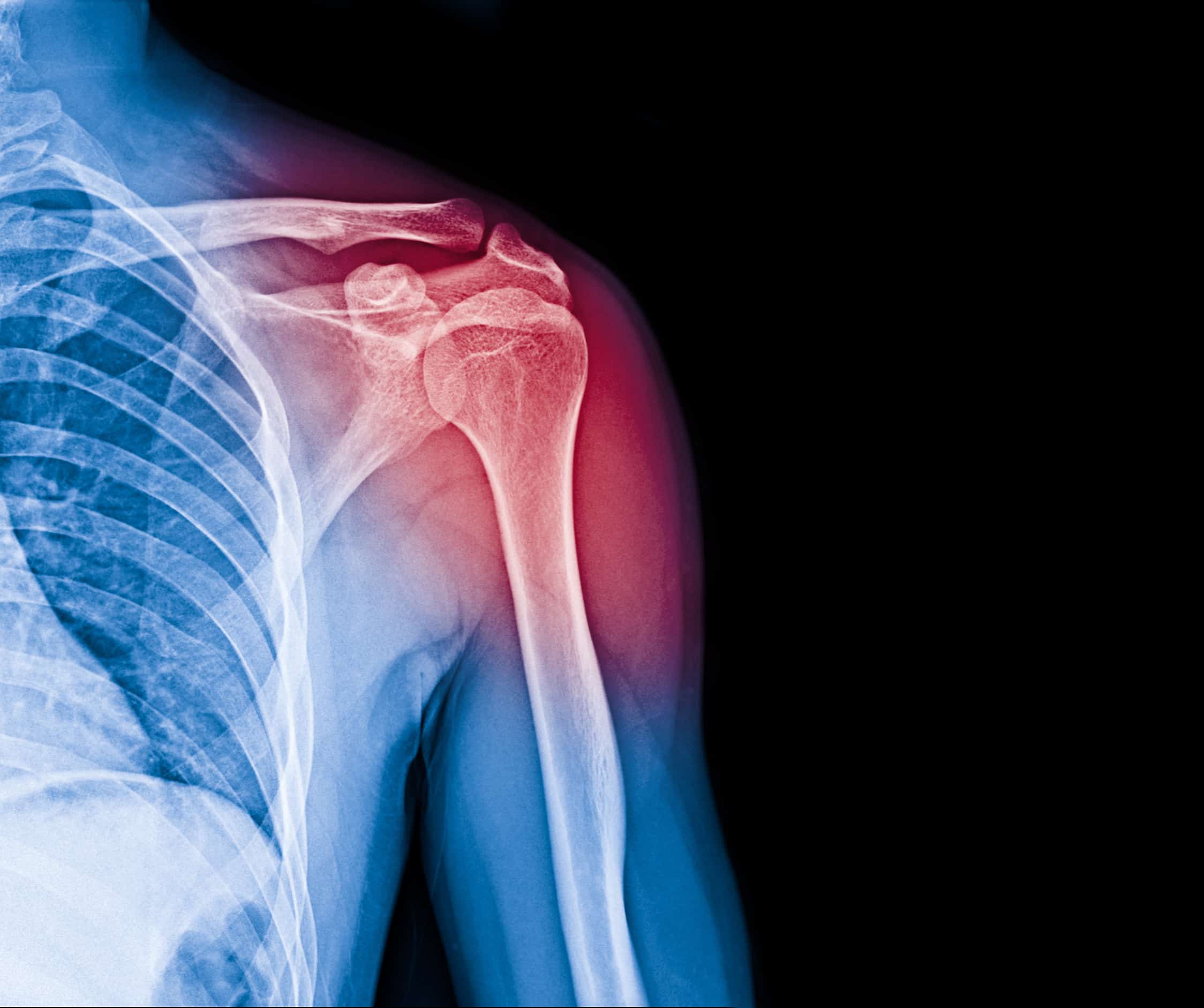 健康・医学 Shoulder Injuries in the Athlete How Common are Shoulder Injuries in Athletics?